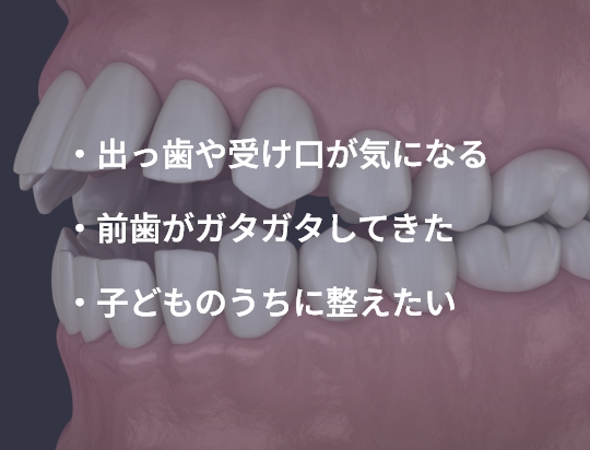 ・出っ歯や受け口が気になる ・前歯がガタガタしてきた ・子どものうちに整えたい